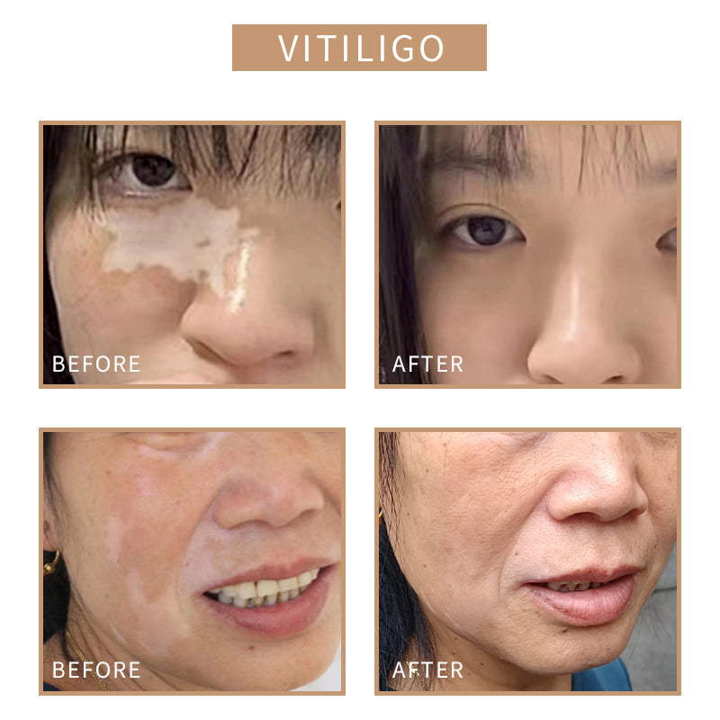 [Sober Skin] Skin Tone Reconstruction Lotion 10ml Semi-Permanent Color Tattoo Pigment Used To Cover Scars, Dark Circles, Stretch Marks, Growth Lines, White Spots